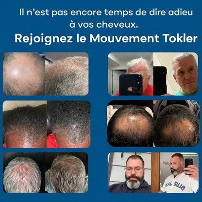 Le système de repousse capillaire par infusion de peptides le plus puissant