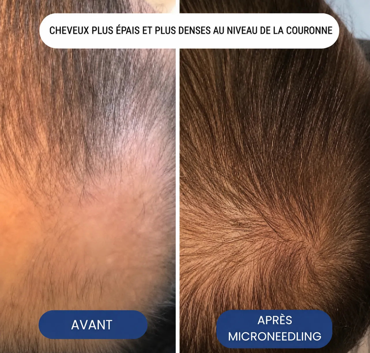 Le système de repousse capillaire par infusion de peptides le plus puissant